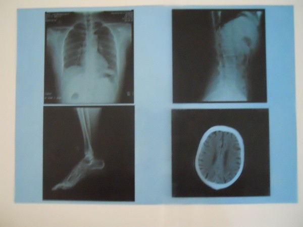Film Fog In Radiography KND-A Low Fog Medical Dry Imaging Film For X Ray Examination On AGFA ...