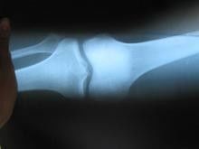 Good price Scratch-resistant 25cm * 30cm Medical Film Xray Paper For Konida Laser Printer online
