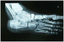 Good price 13in x 17in Degradable X Ray Diagnostic Imaging Medical Paper For Laser Printer online