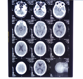 Good price Custom 8 X 10 Digital Medical Dry Film online